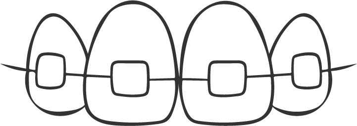 Strichgrafik von Zähnen mit einer festen Zahnspange, bestehend aus Brackets und einem Drahtbogen, zur Darstellung kieferorthopädischer Behandlungen.